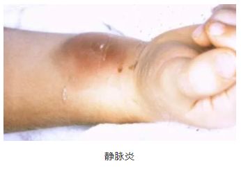 血栓和静脉炎